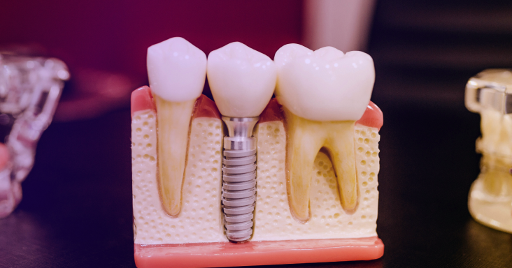 İmplant Tedavisi